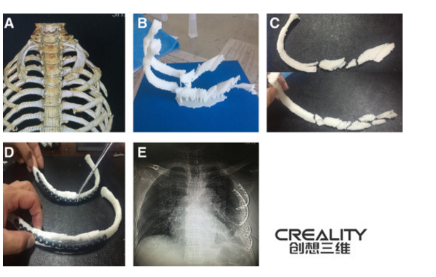 3d打印机改善肋骨骨折手术的可行性研究 维科号