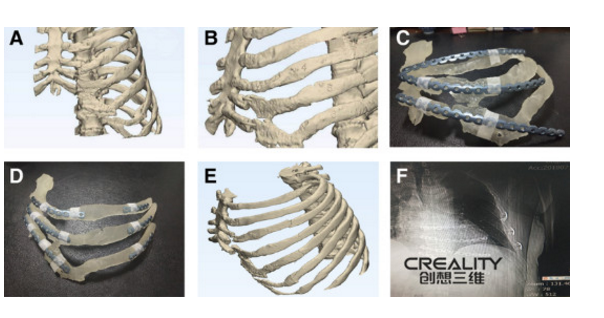 3d打印机改善肋骨骨折手术的可行性研究 维科号