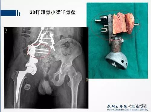 深圳二院 华南地区首例骨盆巨大肿瘤摘除手术顺利完成 维科号